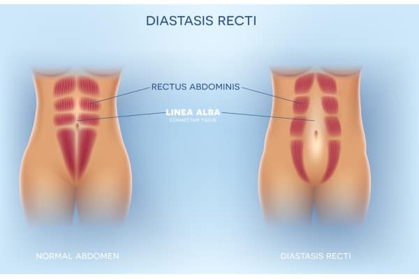 What Non-Surgical Options Are Available for Diastasis Recti East Grinstead?