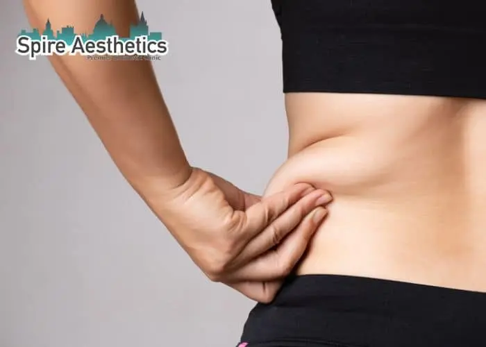 Image of woman pinching fat on their hips East Grinstead. Fat Freezing treatment