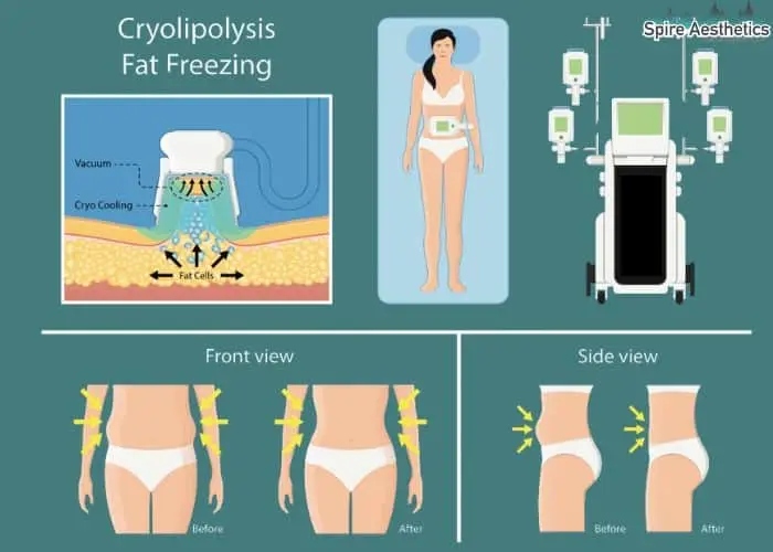 Fat freezing treatment East Grinstead benefits for competitions to remove stubborn fat deposits.