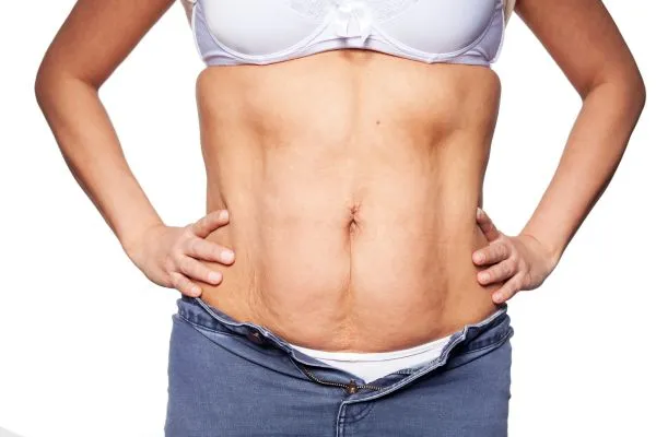 sagging skin on woman's stomach after weight loss injections East Grinstead