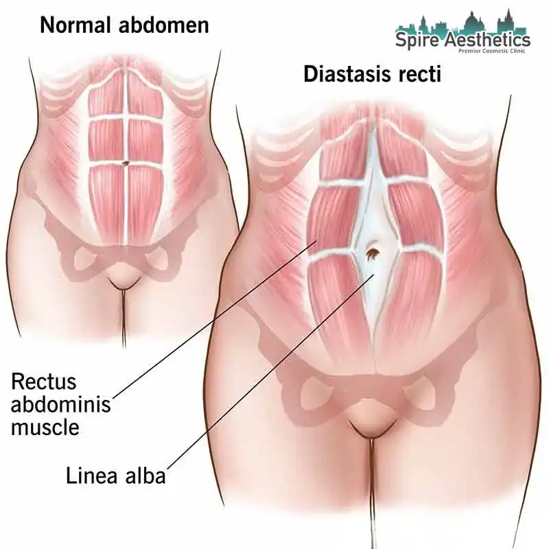 When Will My Belly Feel Normal Again East Grinstead?